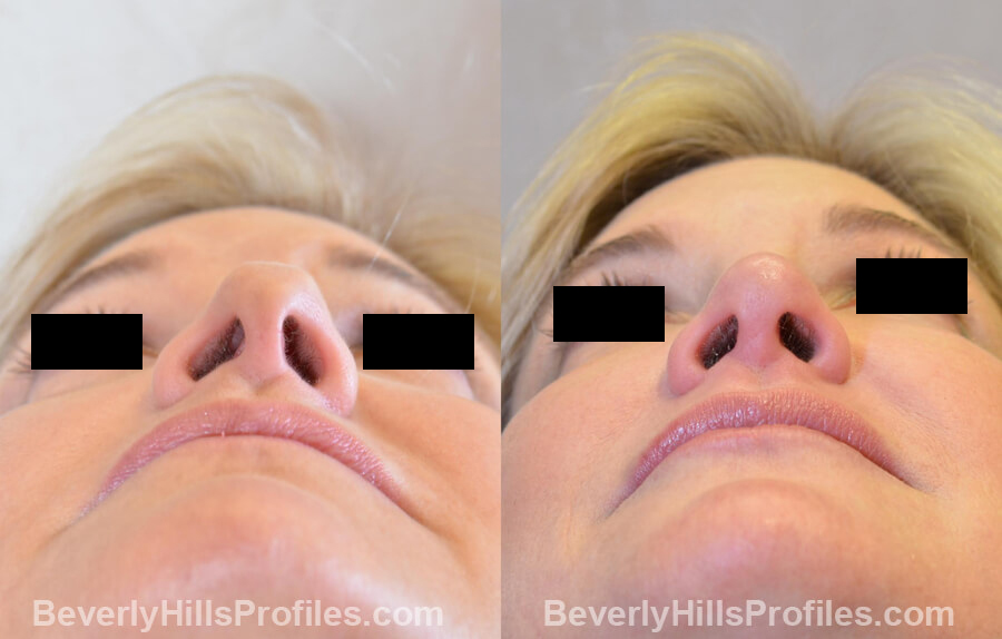 Photos Female patient before and after Revision Nose Job, underside view
