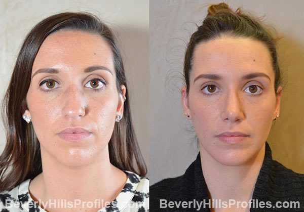 Female face, before and after Chin Implant treatment, front view, patient 11