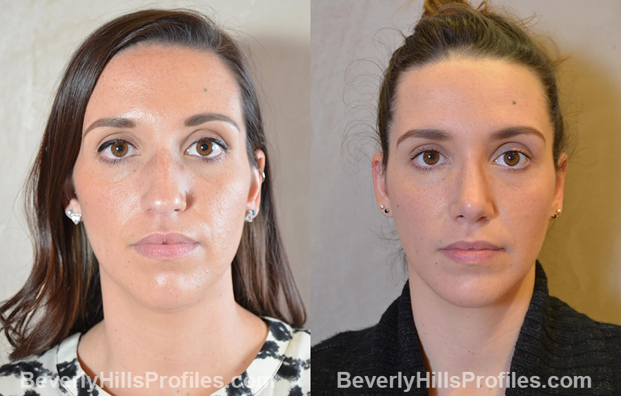 Female patient before and after Chin Implants - front view