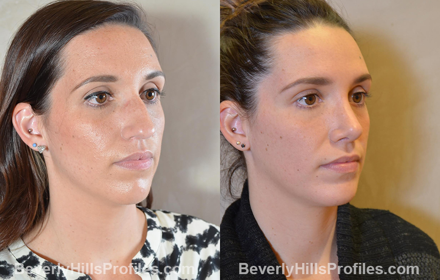 imgs Female patient before and after Nose Surgery Procedures - oblique view
