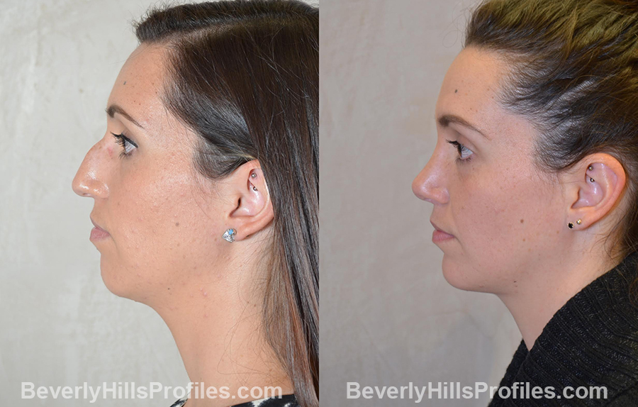 imgs Female patient before and after Nose Surgery Procedures - right side view