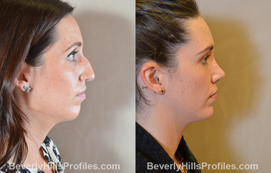 imgs Female patient before and after Nose Surgery Procedures - left side view
