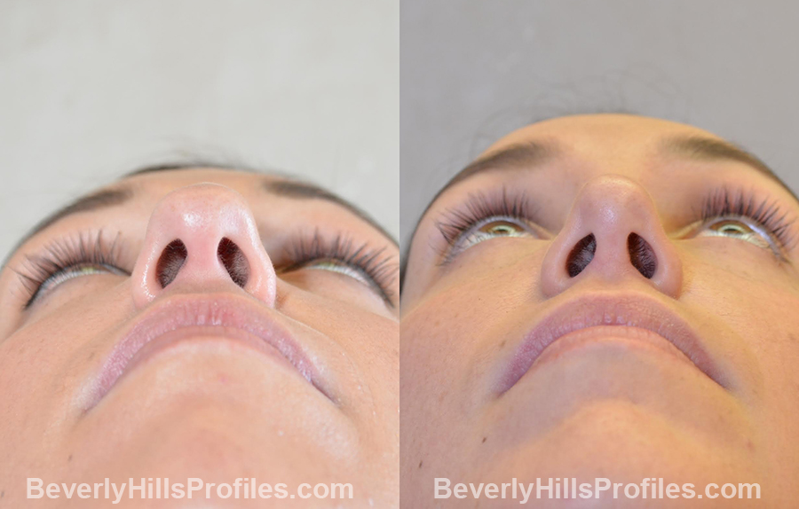imgs Female patient before and after Nose Surgery Procedures - underside view