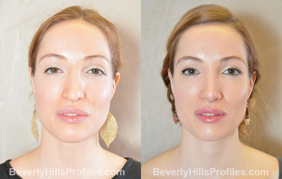 Female patient before and after Revision Nose Job, front view