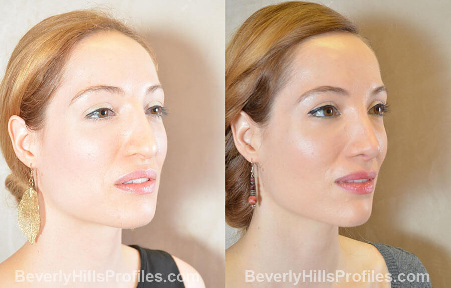 Female patient before and after Revision Nose Job, oblique view