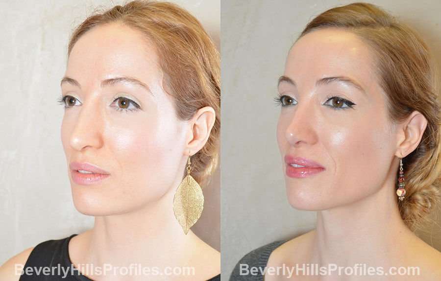 Female patient before and after Revision Nose Job, left oblique view
