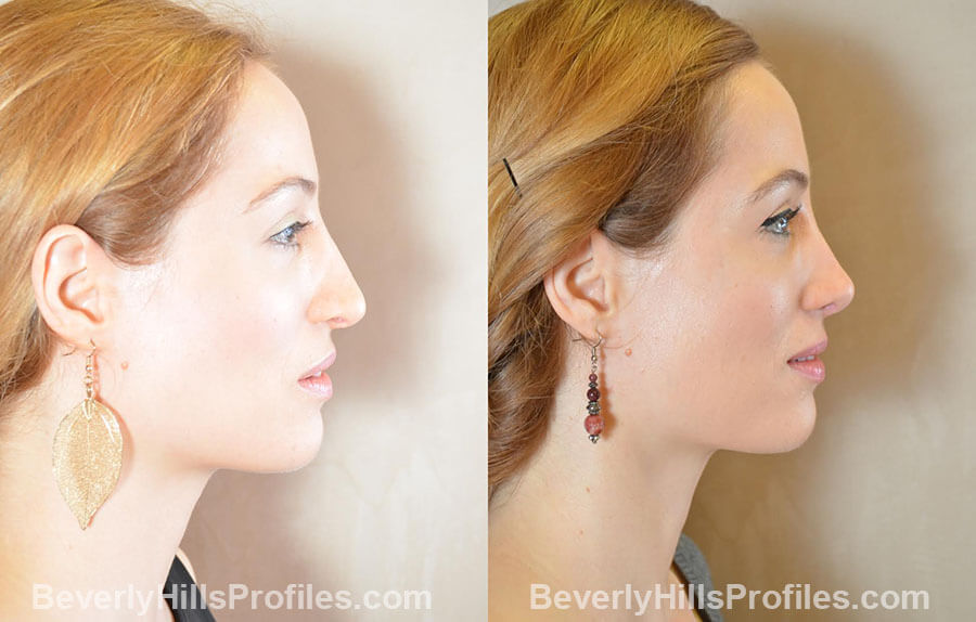 Female patient before and after Revision Nose Job, left side view