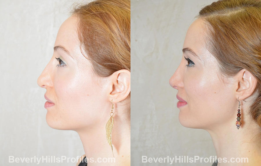 Female patient before and after Revision Nose Job, side view