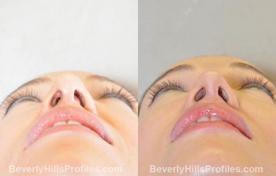 Female patient before and after Revision Nose Job, underside view