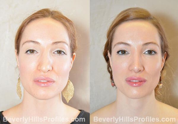 Revision Rhinoplasty Before and After Photo Gallery - front view, female patient 34