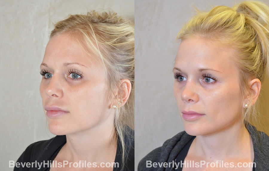 patient before and after Revision Nose Job, left oblique view