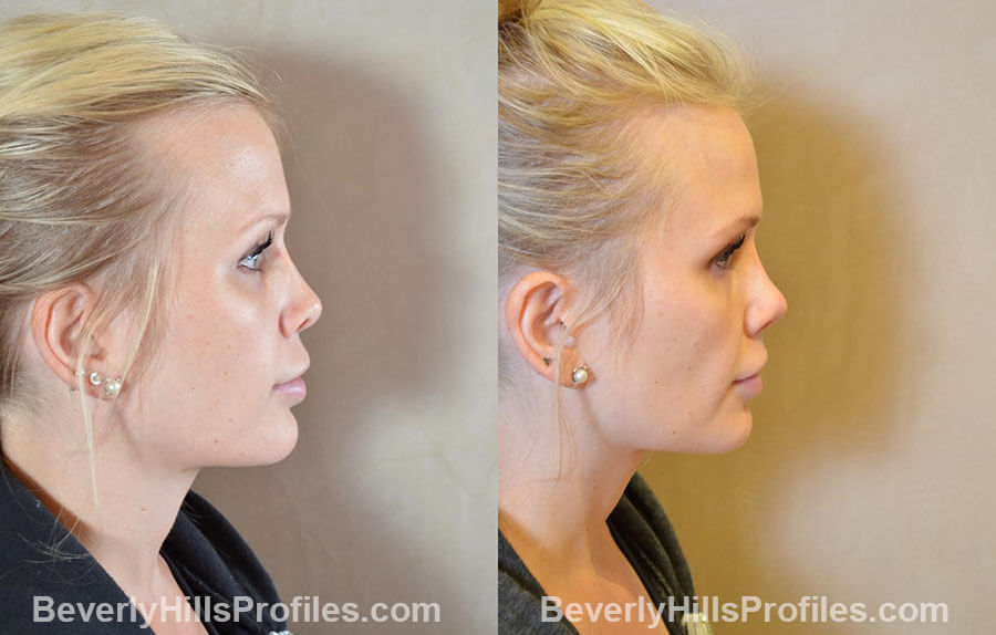 Female patient before and after Revision Nose Job, side view