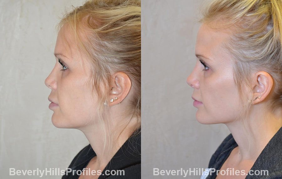 Female patient before and after Revision Nose Job, left side view