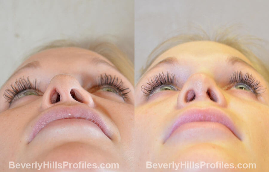 Female patient before and after Revision Nose Job, underside view
