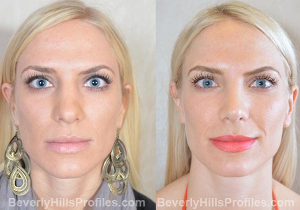 Revision Rhinoplasty Before and After Photo Gallery - front view, female patient 7