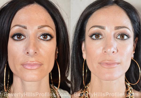 Revision Rhinoplasty Before and After Photo Gallery - front view, female patient 8