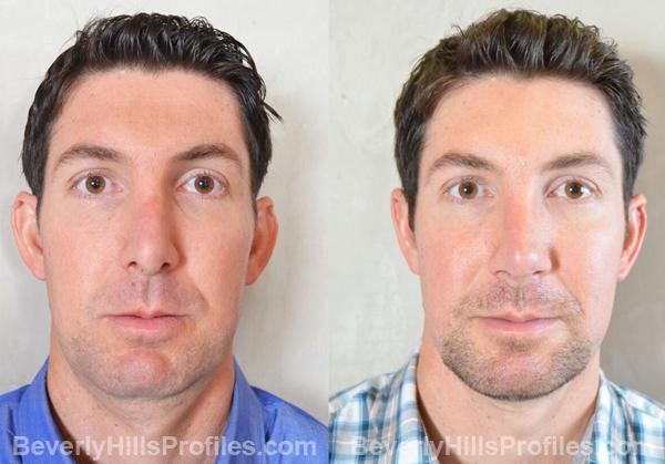 Revision Rhinoplasty Before and After Photo Gallery - front view, male patient 28