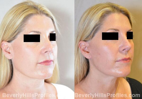 Revision Rhinoplasty Before and After Photo Gallery - front view, female patient 30