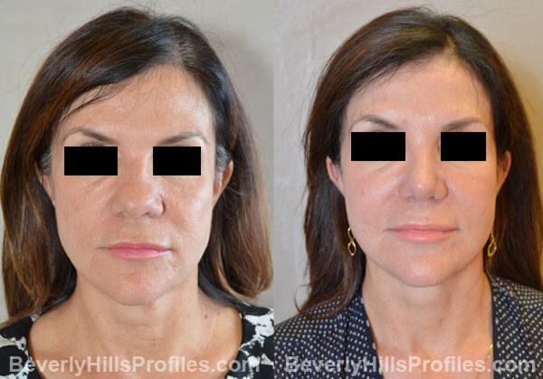 Revision Rhinoplasty Before and After Photo Gallery - front view, female patient 31