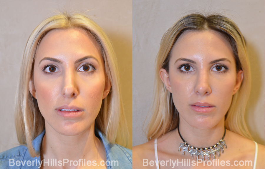 front view - Female patient before and after Revision Rhinoplasty