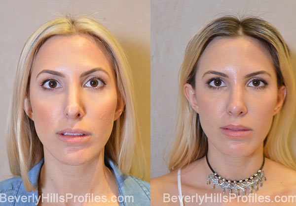 upturned nose caused by silicon implant - Revised rib carilage rhinoplasty  > Before & After Photo