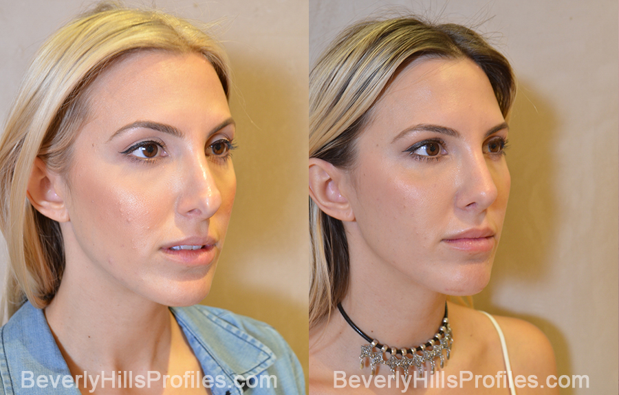 oblique view - Female patient before and after Revision Rhinoplasty