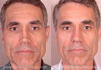 Revision Rhinoplasty Before and After Photo Gallery - front view, male patient 5