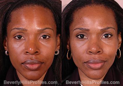 Revision Rhinoplasty Before and After Photo Gallery - front view, female patient 17