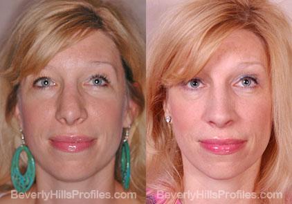 Revision Rhinoplasty Before and After Photo Gallery - front view, female patient 16