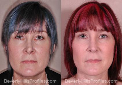 Revision Rhinoplasty Before and After Photo Gallery - front view, female patient 1