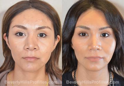 Revision Rhinoplasty Before and After Photo Gallery - front view, female patient 26
