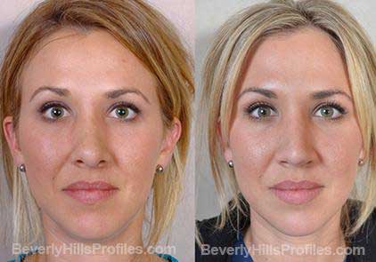 Images Female patient before and after Revision Nose Job