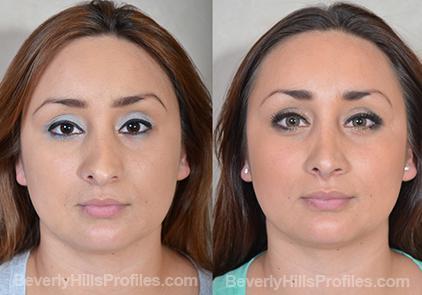 Revision Rhinoplasty Before and After Photo Gallery - front view, female patient 21
