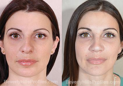 Revision Rhinoplasty Before and After Photo Gallery - front view, female patient 22