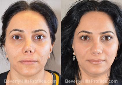 Revision Rhinoplasty Before and After Photo Gallery - front view, female patient 4