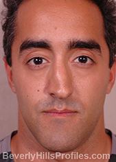 Male face, before Functional Rhinoplasty treatment, front view