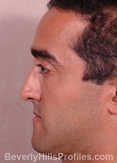 Male face, before Functional Rhinoplasty treatment, left side view