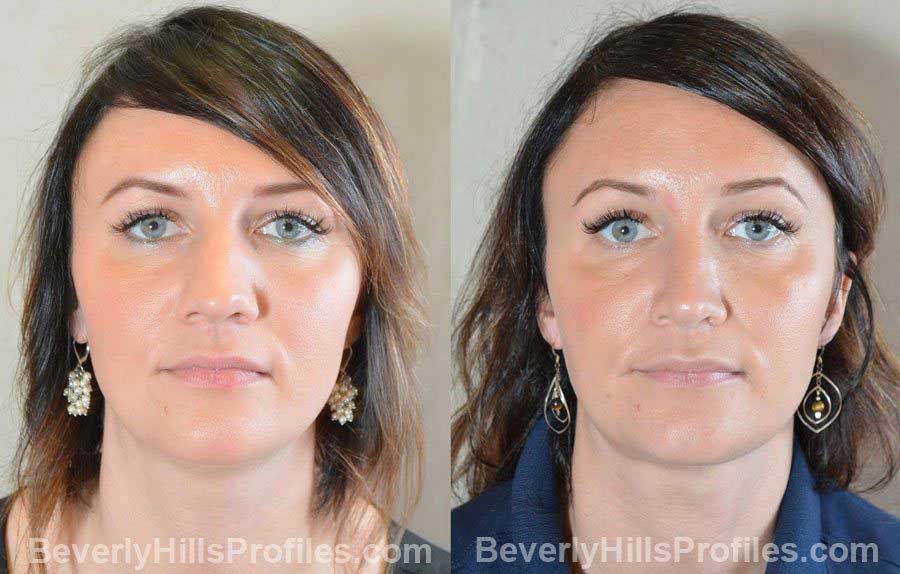 Female patient before and after Nose Surgery - front view