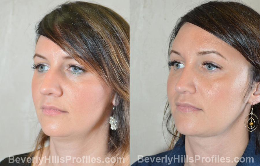 Female patient before and after Nose Surgery - oblique view