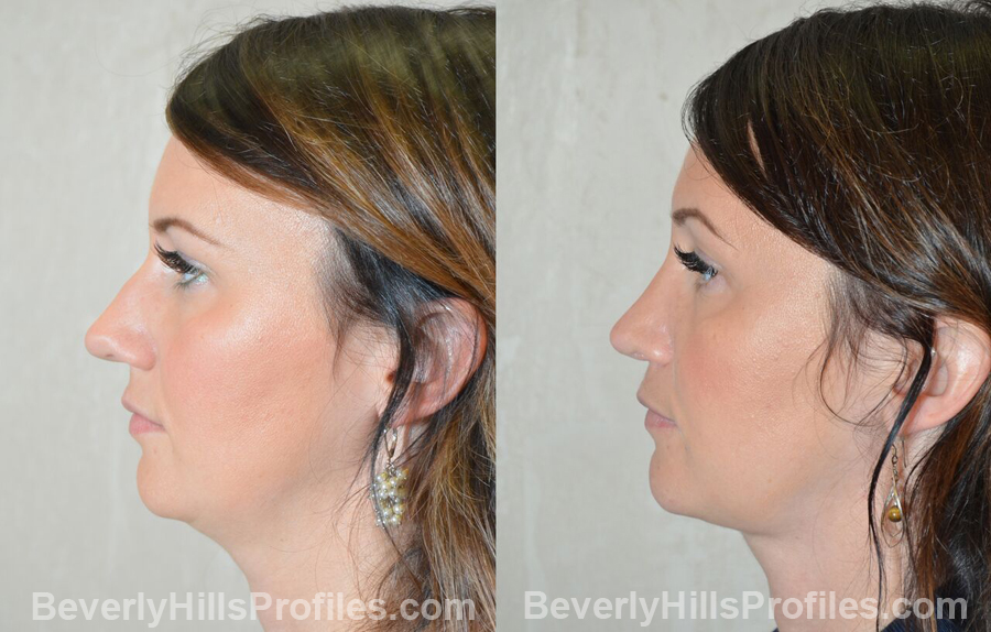 Rhinoplasty Before and After - female, side view