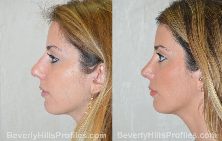 imgs Female patient before and after Nose Surgery, side view