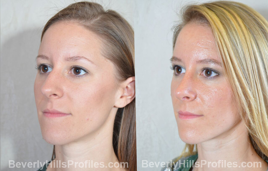 pics Female patient before and after Nose Surgery - oblique view