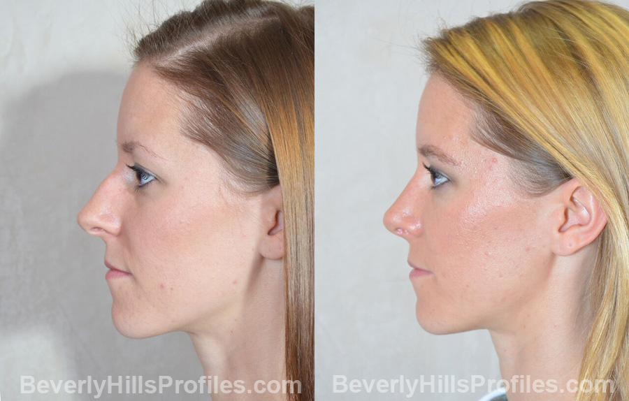 pics Female patient before and after Nose Surgery - side view