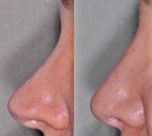 Male face, nose - before and after Rhinoplasty Mistakes treatment