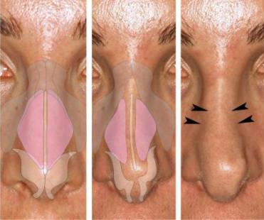 two types of nasal valve collapse

