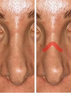 Patient nose, before and after Rhinoplasty Mistakes treatment, front view