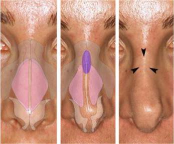 Patient nose, before and after Rhinoplasty Mistakes treatment - front view