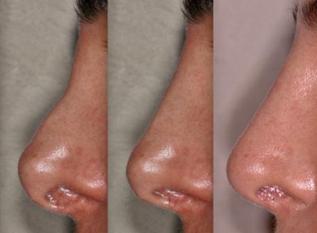 Patient face, nose - before and after Rhinoplasty Mistakes treatment