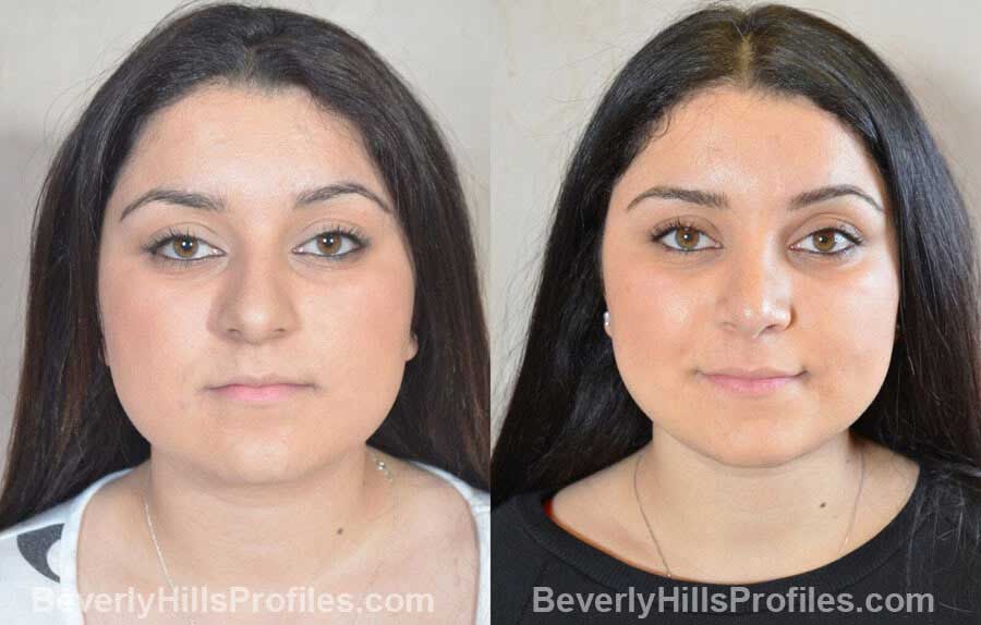 pics Female patient before and after Nose Surgery front view