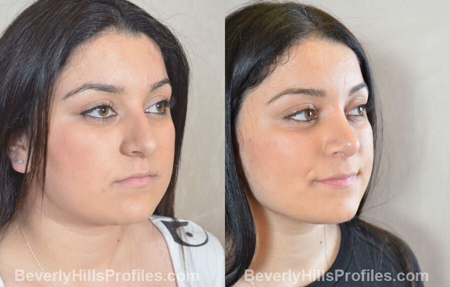 pics Female patient before and after Nose Surgery oblique view